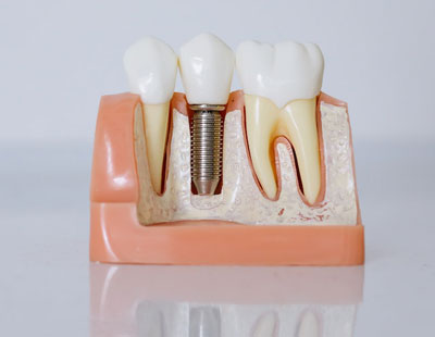 Dental Implants Herriman